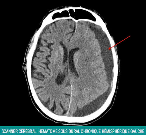 Implant dentaire