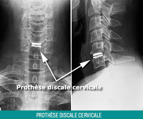 Traitement hernie discale cervicale Tunisie : Dr Chokri Sanaa