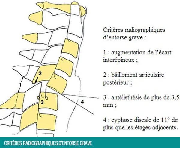 Traitement fractures entorses du rachis Tunisie : Dr Chokri Sanaa